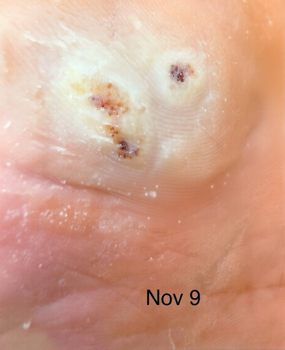 November 9: black dots and lobules indicating persistent wart under keratin