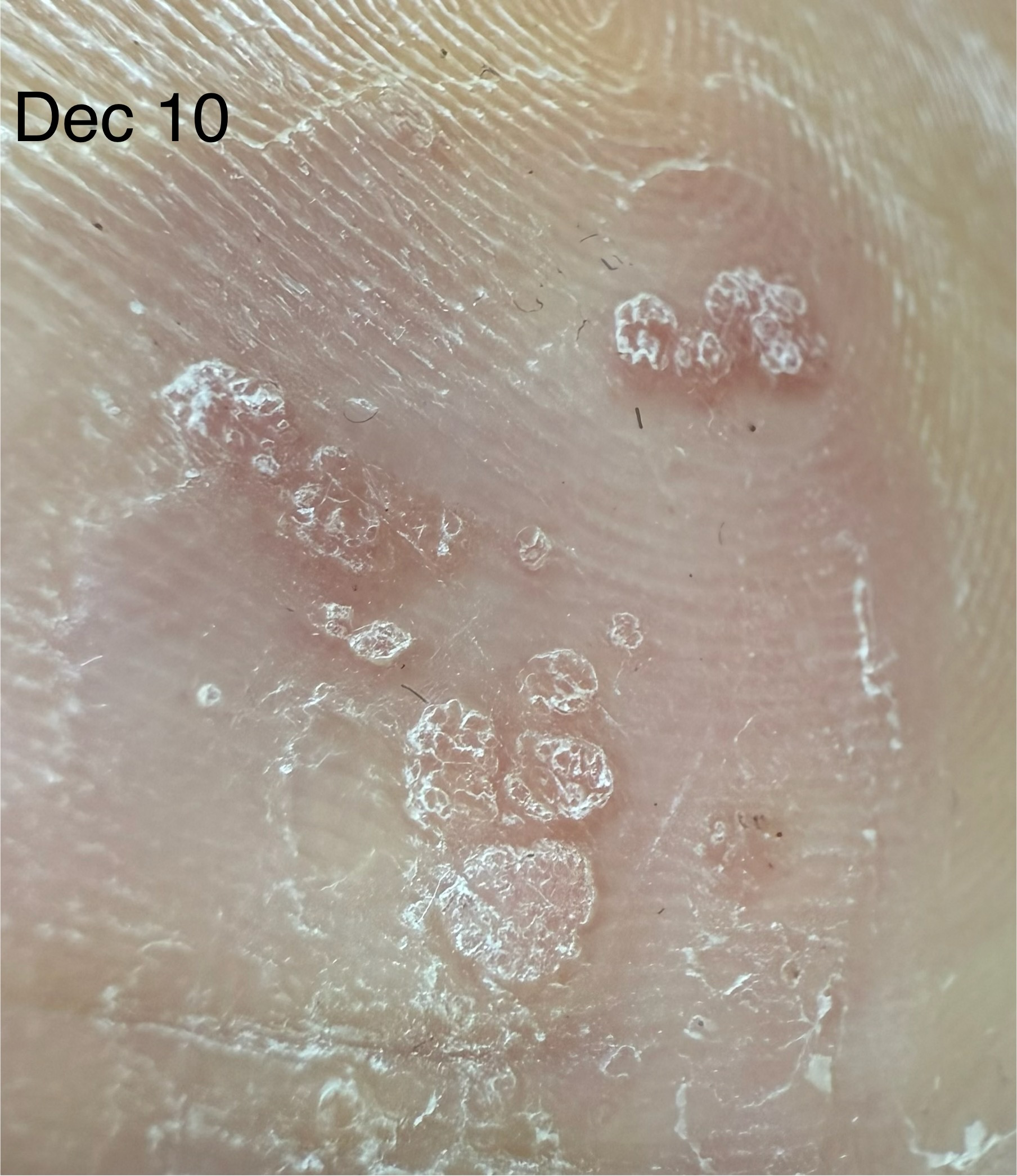 December 10: post-clearance remodeling and reactive hyperkeratosis